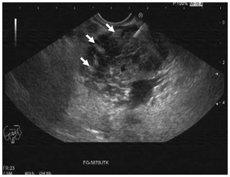 Pancreatic Lymph Nodes