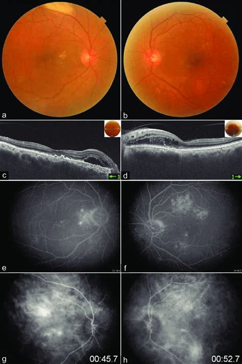 Colour fundus photo shows multiple yellowish drusen like exudates with ...