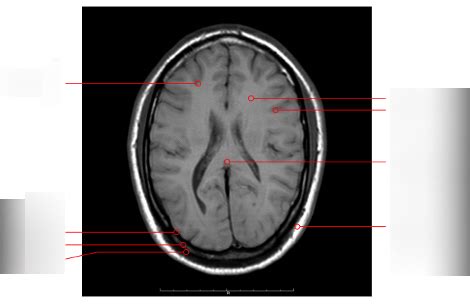 Diagram Radiologie Anatomie Hersenen 11 Quizlet