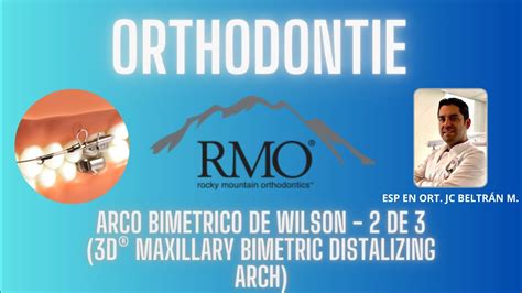 Arco Bimetrico De Wilson 2 De 3 3d® Maxillary Bimetric Distalizing