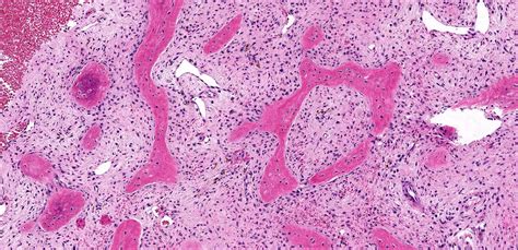 Polyostotic Fibrous Dysplasia Histology