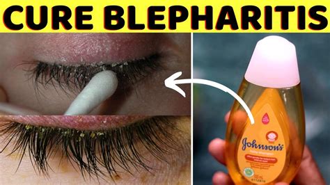 How To Cure Blepharitis Naturally Fast And Quickly At Home Using Coconut Oil Youtube