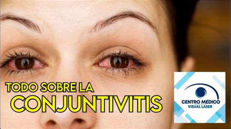 Conoce Todo Sobre La Conjuntivitis Youtube