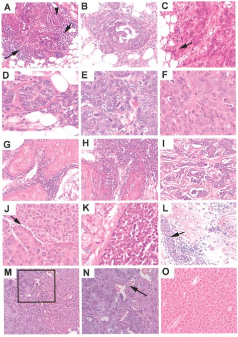 Histologic Diversity Of Mammary Tumors Found In Brca1 Conditional