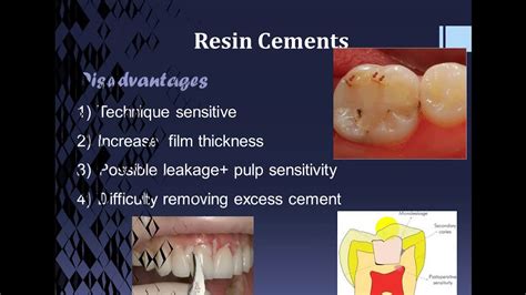 Dental Resin Cement Youtube