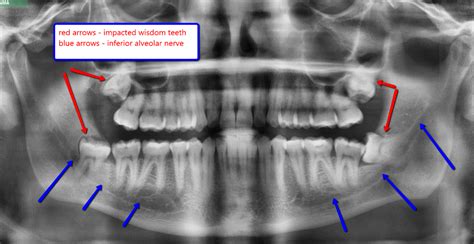 Tooth Nerve Removal