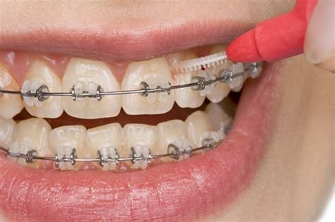 Braces and Hygiene: What to Use - Orthodontic Associates