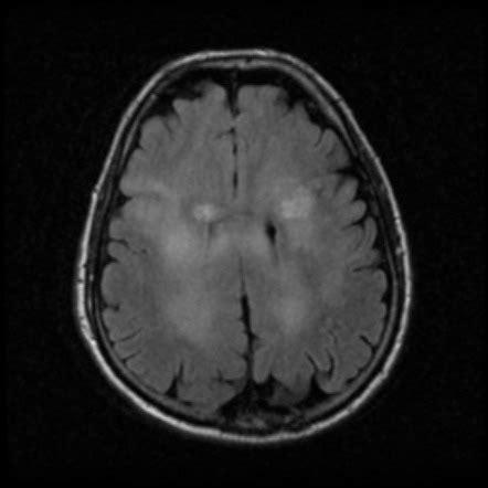 Glioblastoma IDH wild-type (multifocal) | Radiology Case | Radiopaedia.org