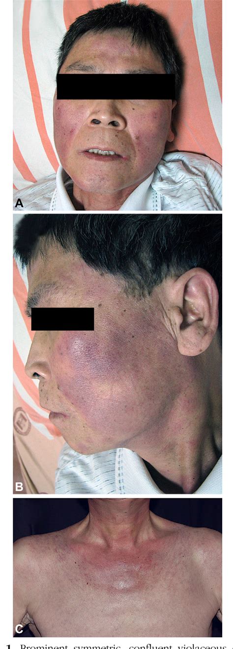 Figure From Subcutaneous Panniculitis Like T Cell Lymphoma Presenting