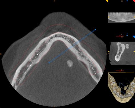 Dr. Gabbaypour, DDS, MD: Salivary Gland stone