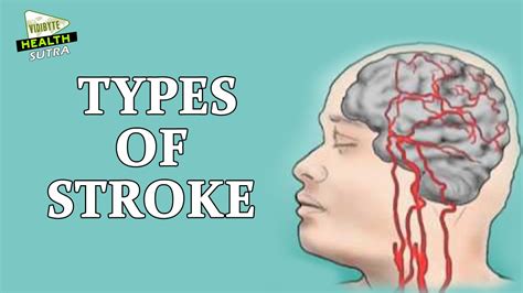 Types Of Stroke Youtube