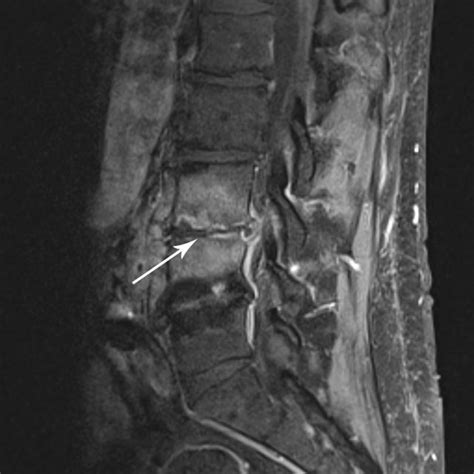 Magnetic Resonance Imaging MRI Of The Lumbar Spine Demonstrating