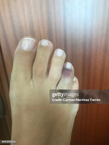 Bruised Toes Photos And Premium High Res Pictures Getty Images