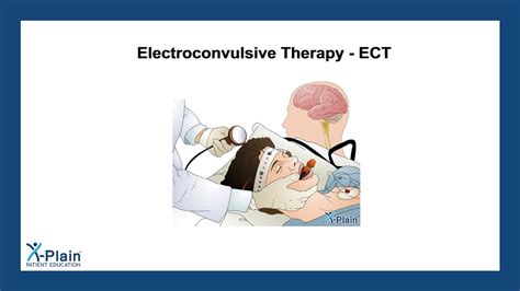 Electroconvulsive Therapy Ect Youtube