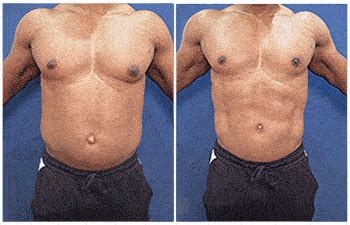 High Definition Liposuction Male Chest Best In 2024