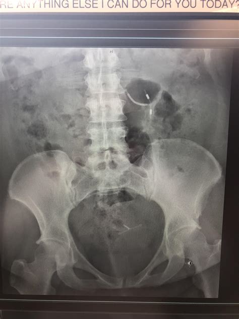 Copper Iud Side Effects Stomach Pain at Molly Stinson blog