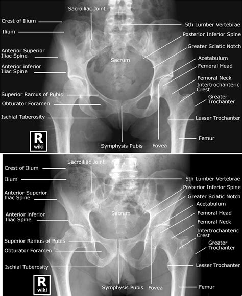 Male versus Female Pelvis – Labeled Radiographic Anatomy | Medical ...