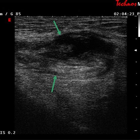 The Cyst Of Spermatic Cord Showed In The Ultrasonography Arrows