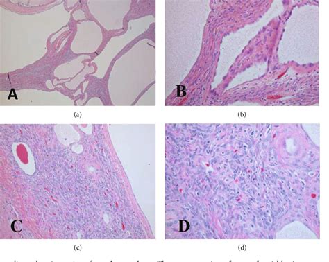 Figure 2 From Mixed Epithelial And Stromal Tumor A Rare Renal Neoplasm