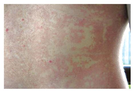 Erythema Marginatum