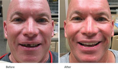 Before And After Results Grace Dental Framingham Ma