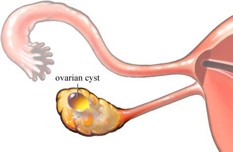 Ovarian Cyst - International Women's Clinic