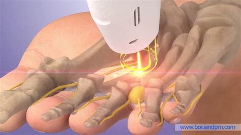 Nd Yag Laser Treatment For Morton S Neuroma And Plantar Fascial