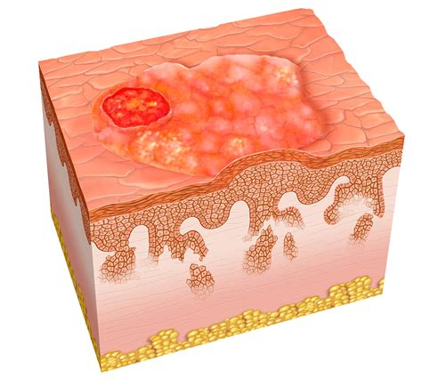 Squamous Cell Carcinoma Skin Histology