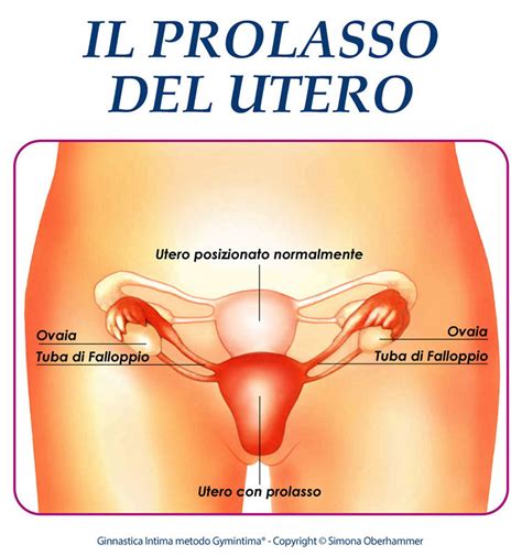 Prolasso Dellutero E Della Vescica La Ginnastica Intima Per La