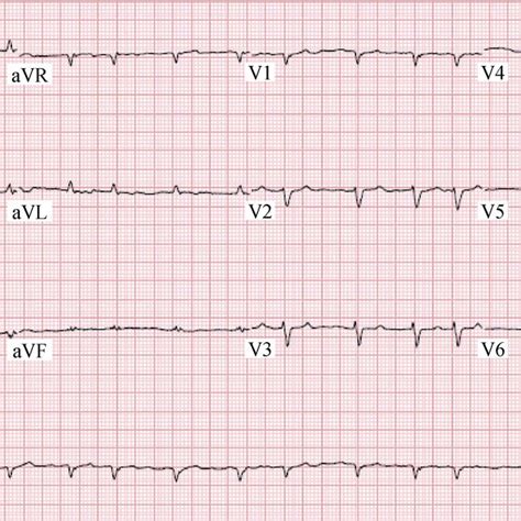 Electrocardiogram Showing Atrial Fibrillation With Rapid Ventricular