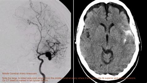 Dr Balaji Anvekar Frcr Imaging In Sub Arachnoid Hrhage