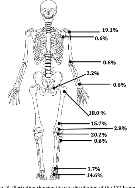 Chondroblastoma In Pelvis And Extremities A Signle Centre Study Of 177