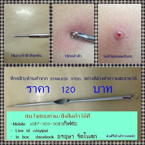 ประมูลสินค้าใหม่ ที่กดสิว ลดปํญหาสิวที่ต้องแกะบีบ จนอักเสบเป็น