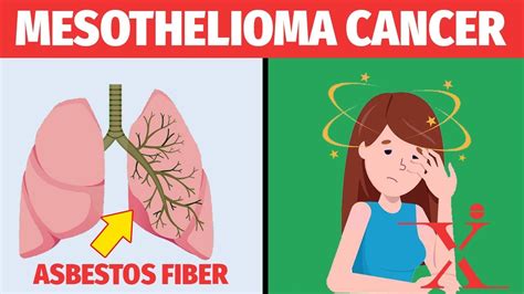 Early Symptoms Of Mesothelioma 2022E Jurnal