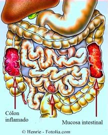Cólon Sigmoide Inflamado Sintomas - Cólon inflamado, sintomas e causas, consequência