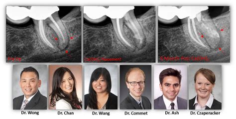 VERTICAL ROOT FRACTURE | Renovo Endodontic Studio