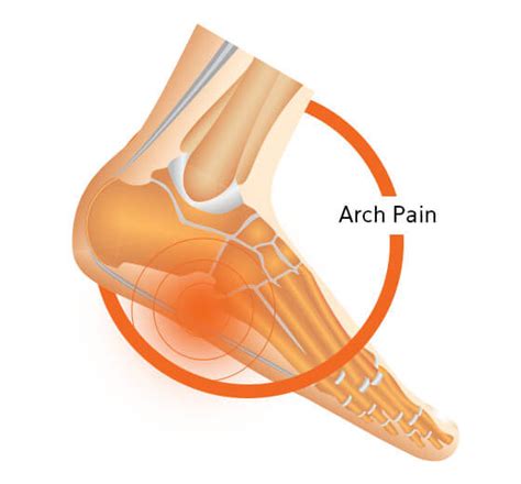 Pain In Arch Of Foot | Pain Under Foot | FootActive