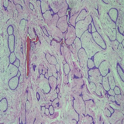 Low Power Microscopy Showing Histopathologic Features Of A Fibroadenoma