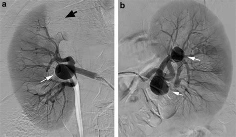 Treatment Dilemma—bilateral Renal Artery Aneurysms Kidney International