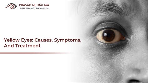 Yellow Eyes: Causes, Symptoms, And Treatment