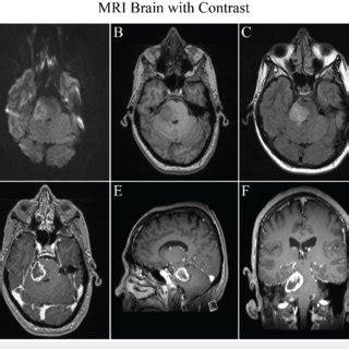 MRI Brain With Contrast At Diagnosis A Diffusion Weighted Imaging