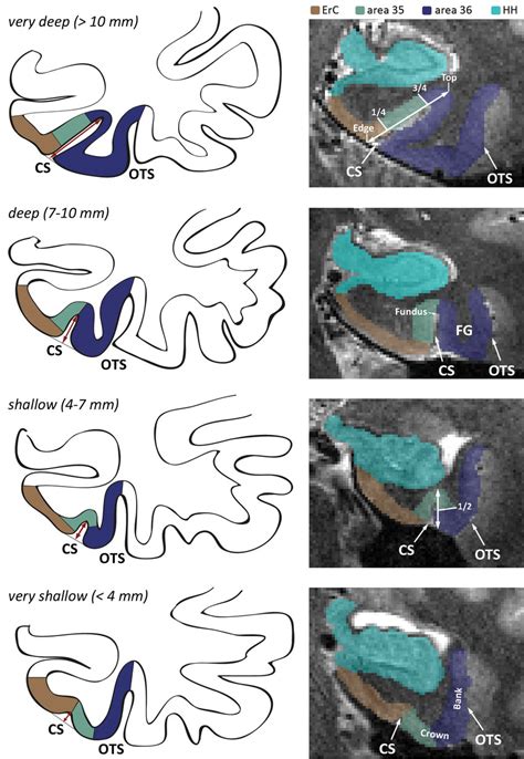 Different depths of the collateral sulcus (CS) with respective... | Download Scientific Diagram