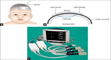 Cerebral Oximetry Sensor Download Scientific Diagram