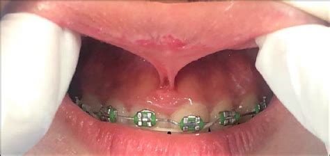 Highly Attached Upper Labial Frenum Download Scientific Diagram