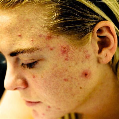 Acne Treatment in London | Advanced Skincare Solutions