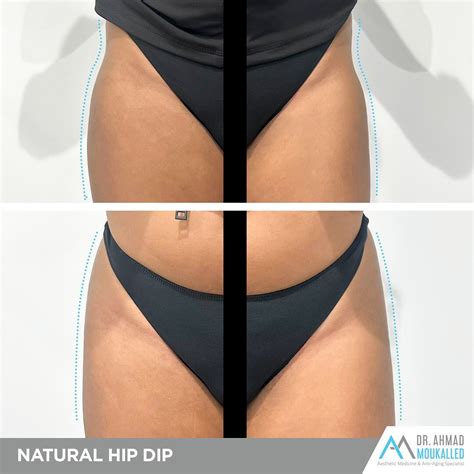 Hip Dips Dr Ahmad Moukalled