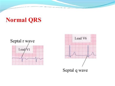 Basics Of Electrocardiographyecg