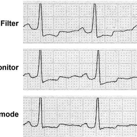 Electrocardiograms Of Same Patient In Different Electrocardiographic