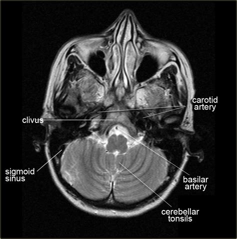 The Radiology Assistant : Brain Anatomy