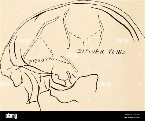 Roentgen Diagnosis Of Diseases Of The Head Fig 31 A Dextrosinistral